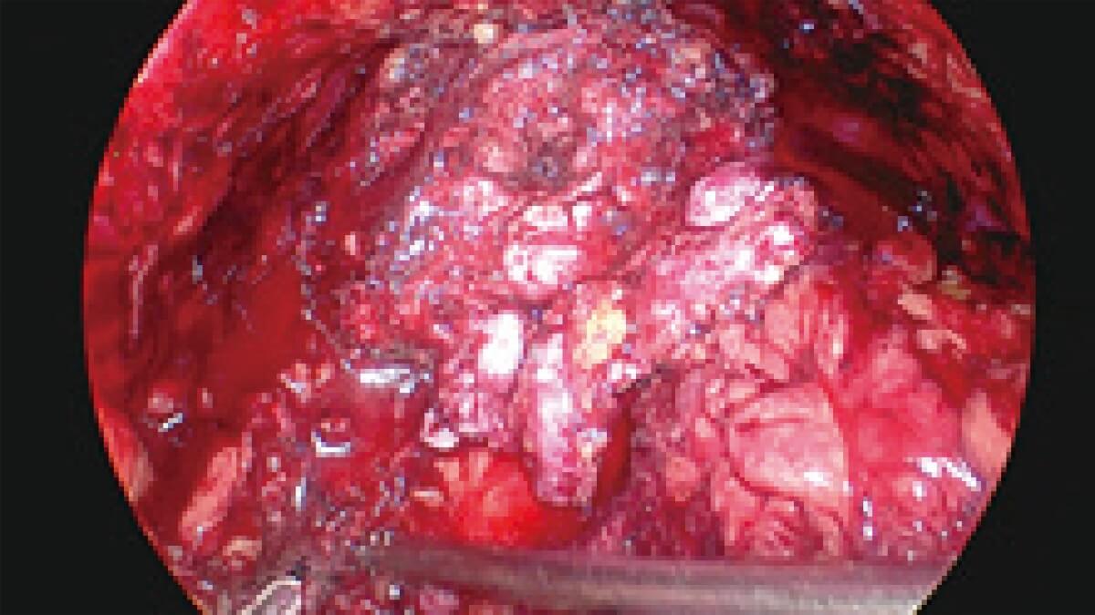 Sistema de videoendoscopia quirúrgica SonoScape SV-M4K30 MIS UHD 4K — imagen 3