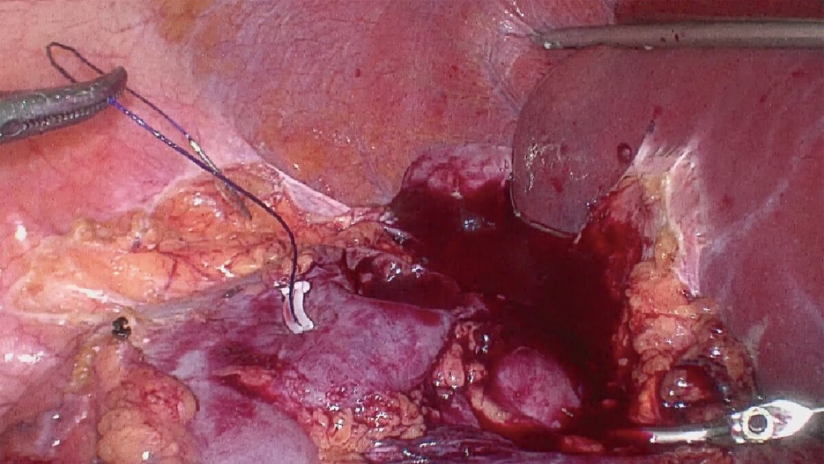 Sistema de videoendoscopia quirúrgica SonoScape SV-M4K30 MIS UHD 4K — imagen 2