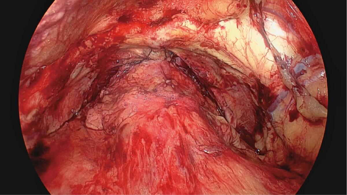 Sistema de videoendoscopia quirúrgica SonoScape SV-M4K30 MIS UHD 4K — imagen 1