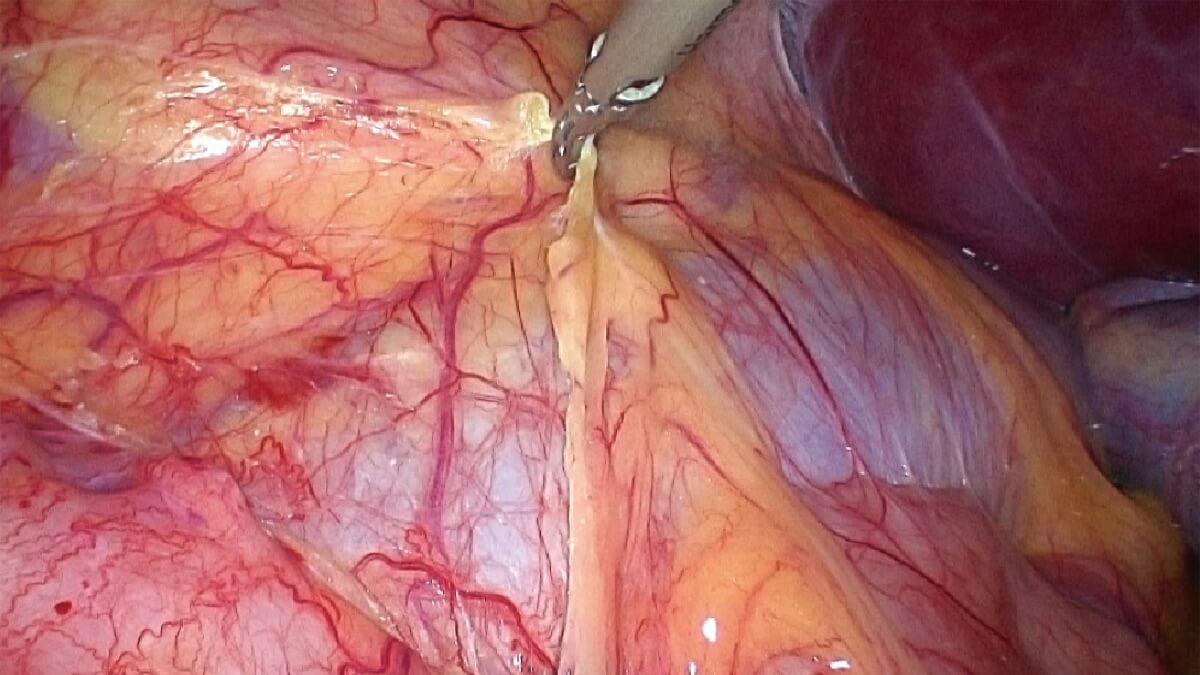 Sistema de videoendoscopia quirúrgica SonoScape SV-M4K30 MIS UHD 4K — imagen 4